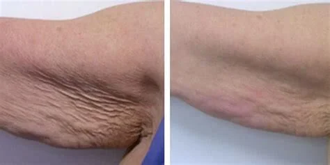 Before and after with XeiuC Collagen Oil